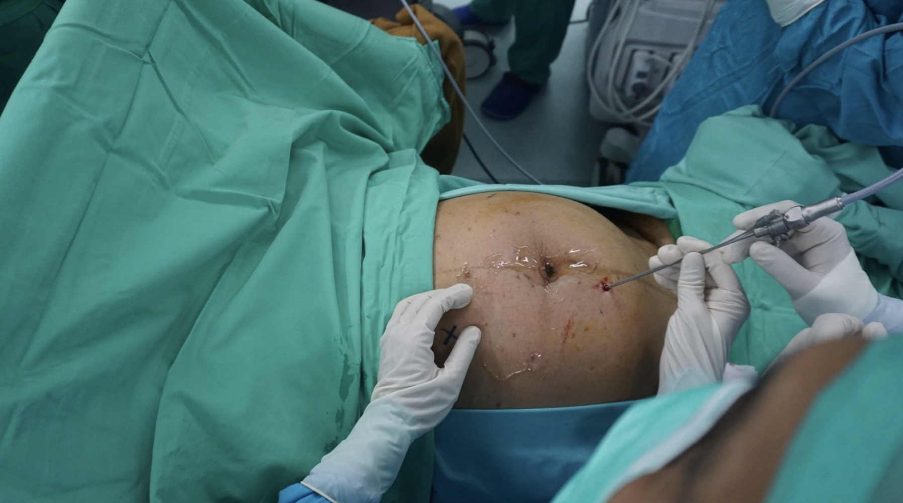 Akses fetoskopi dilakukan secara minimal invasif dengan panduan ultrasonografi