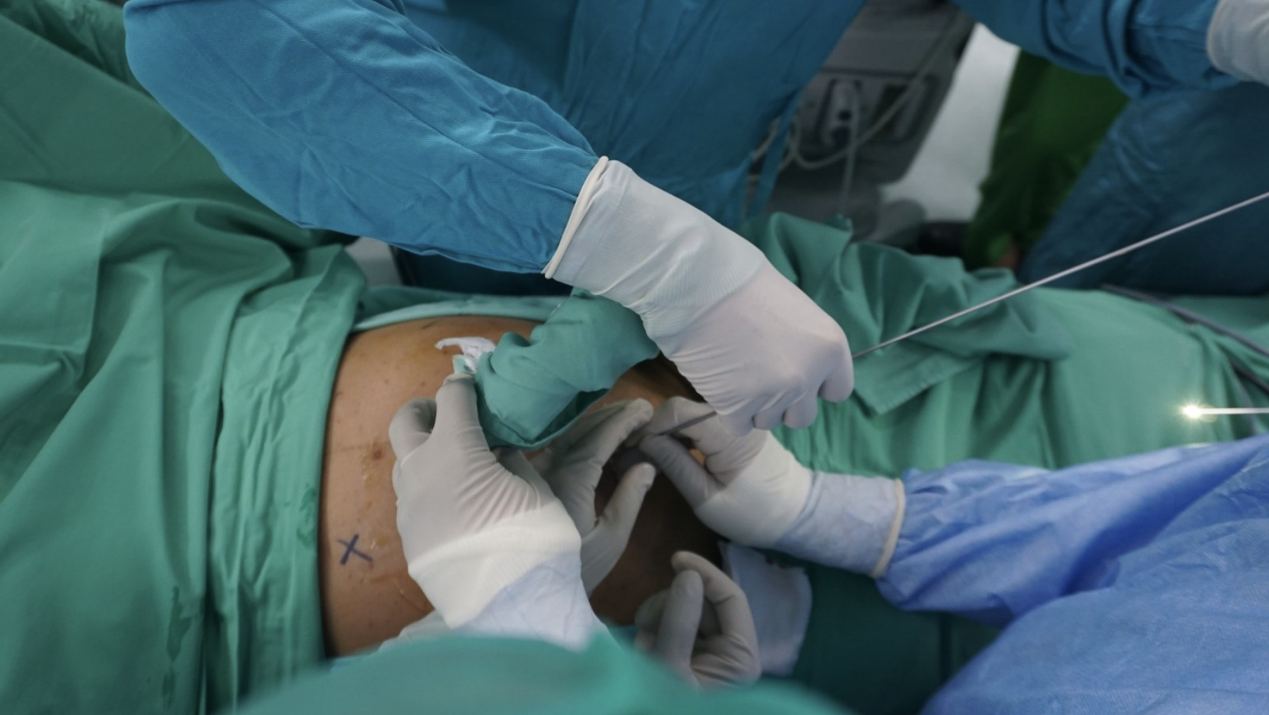 Instrumen fetoskopi digunakan untuk mengidentifikasi dan mengatasi anastomosis vaskular plasenta